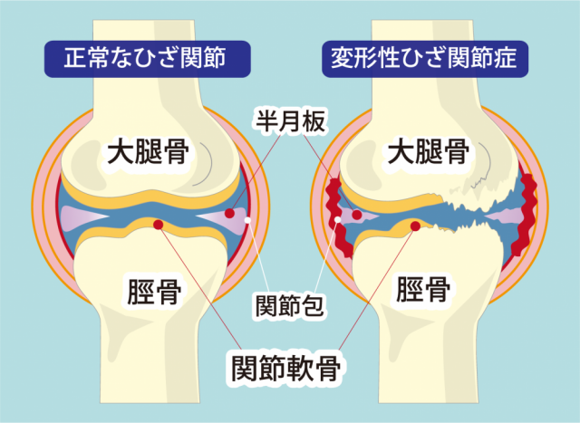 膝痛の原因は?