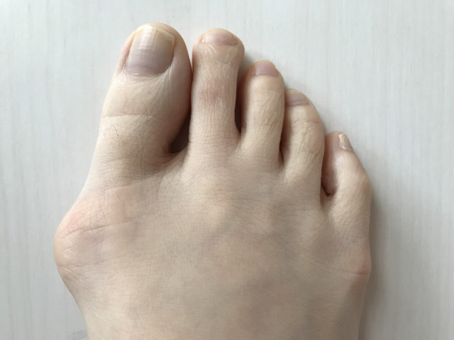 外反母趾の改善に際し、大切にしていることは?